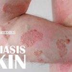 The Best Herbal Remedies To Combat Psoriasis Symptoms#1