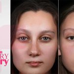 Turbinate Reduction Surgery Recovery​