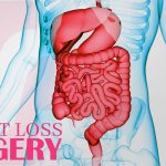 Sadie Weight Loss Surgery