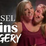 Hensel Twins Surgery: Stunning Secrets Revealed